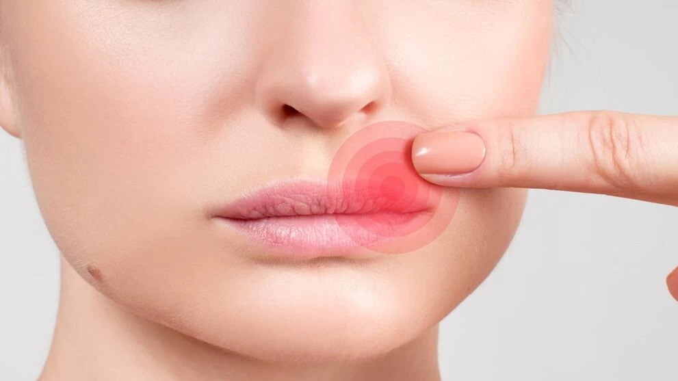 Mindent az ajakherpeszről